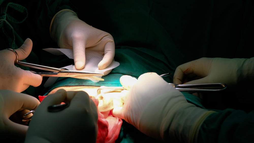 What Is the Status of the Hernia Mesh Lawsuits?