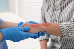Fairfax Burn Injury Lawyer